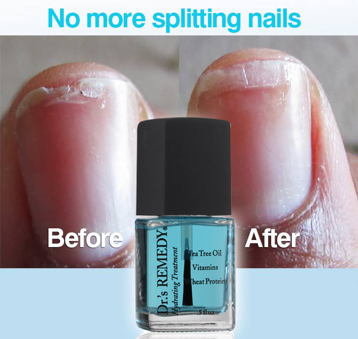 splitting-nails