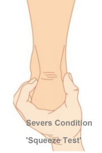 Severs Condition Squeeze test