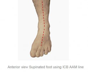 Anterior view Supinated foot using ICB AAM line