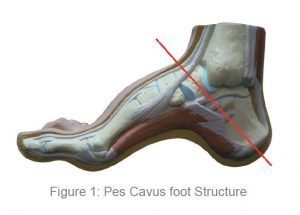 Pes Cavus foot Structure