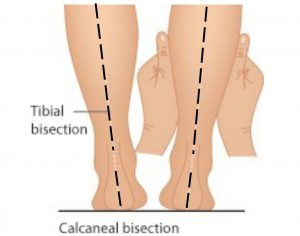 Calcaneal bisection