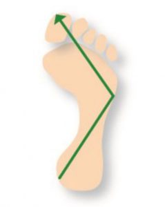 Supinated Foot 