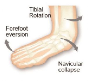 The supinatus foot