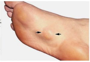 Arch pain when wearing orthotics